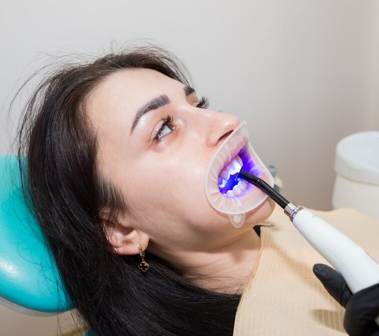 resin veneers