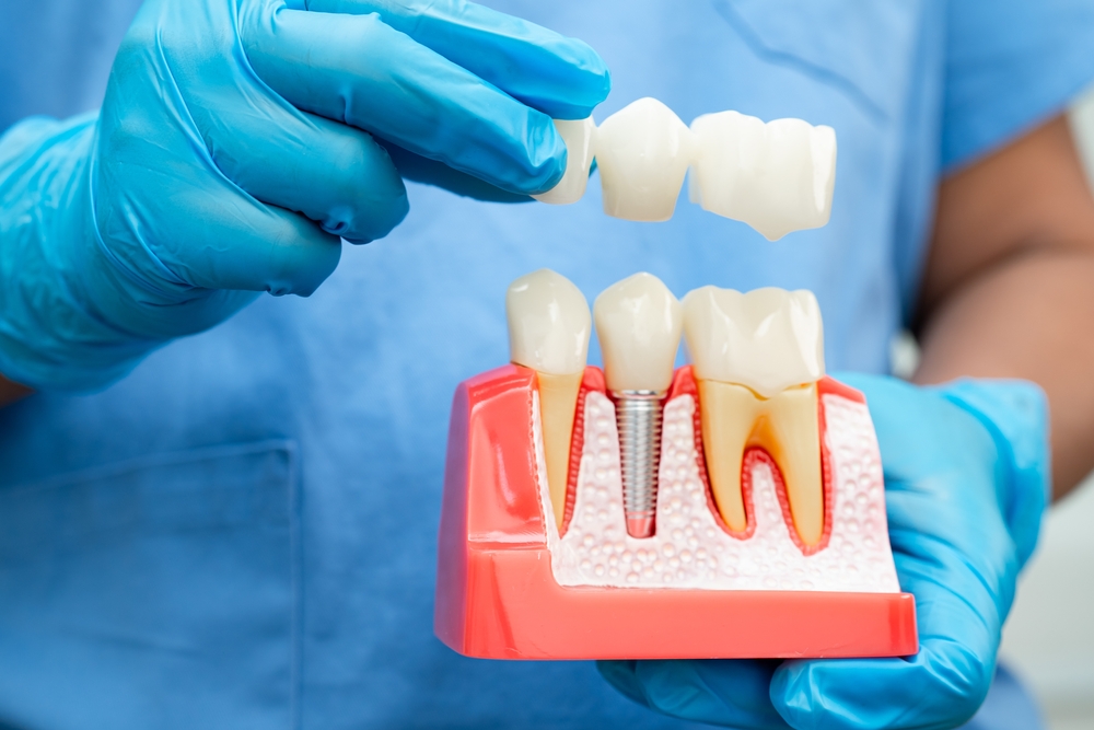 Dental Implants
