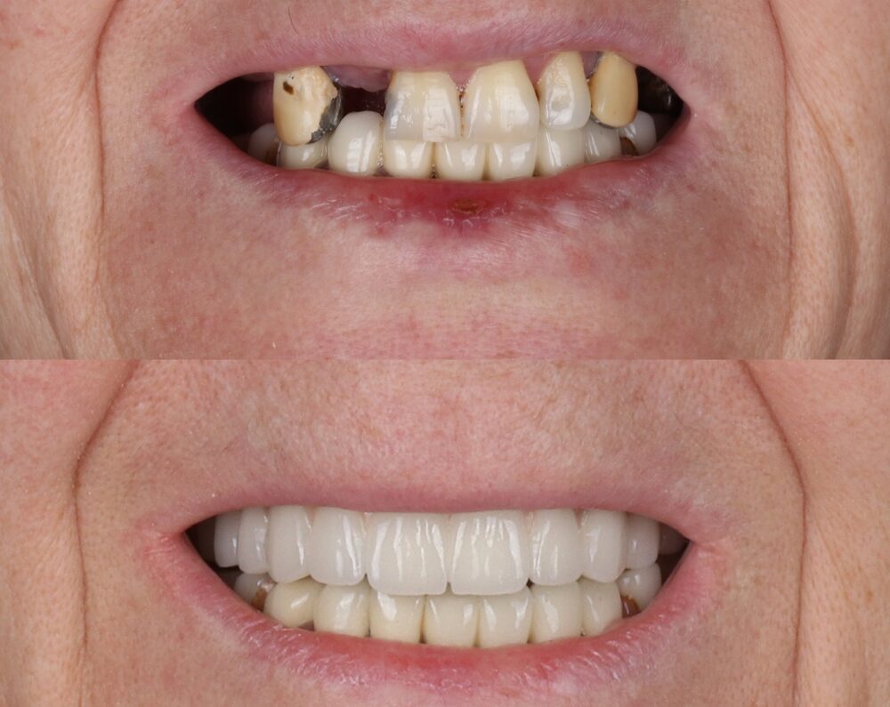 full mouth rehabilitation